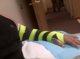 new cast after stiches taken out.jpg